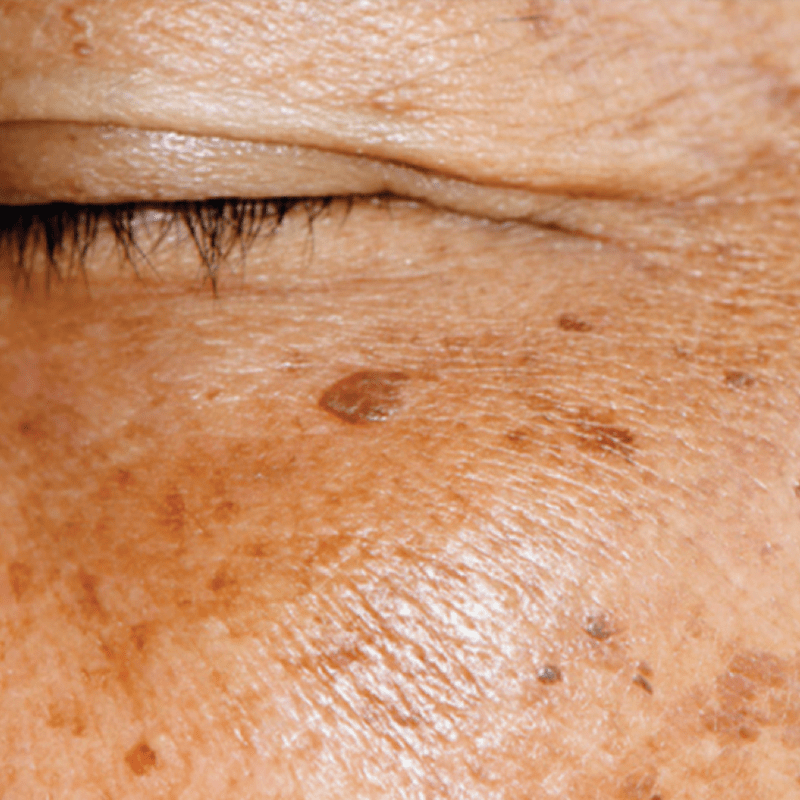 Treating photodamage with NeoGen Plasma