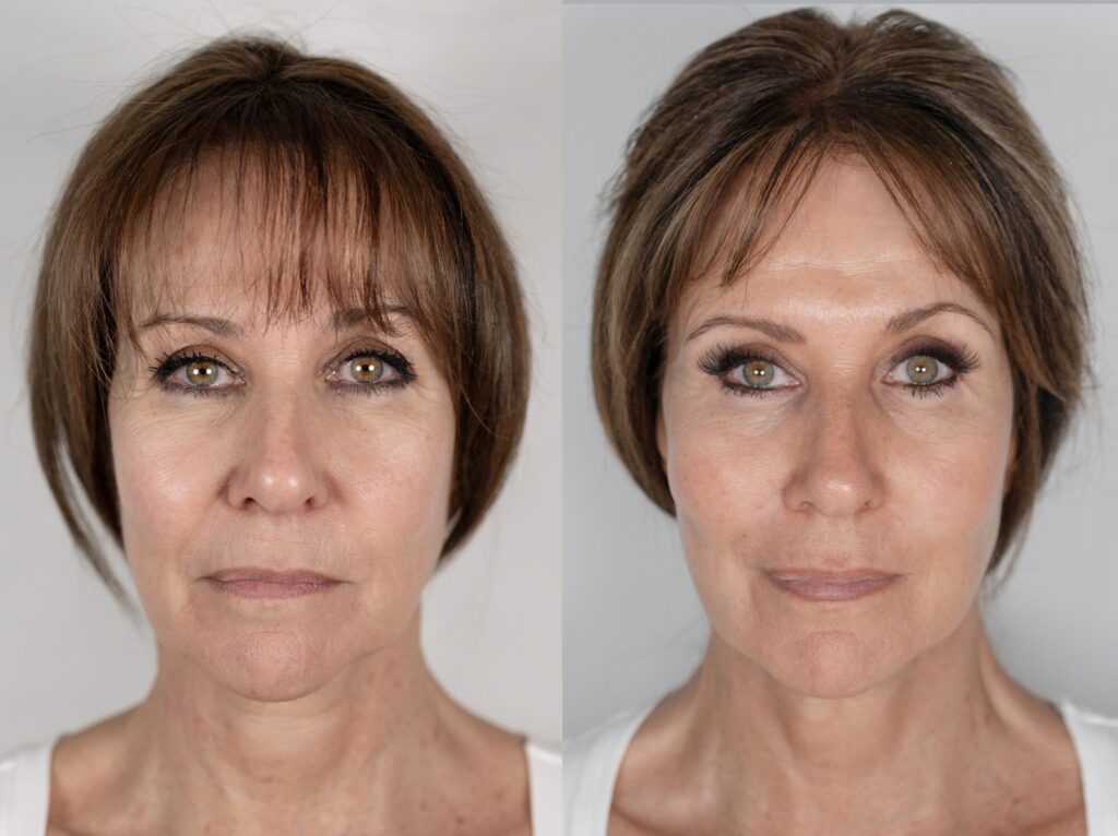 Linda Lusardi’s incredible NeoGen transformation